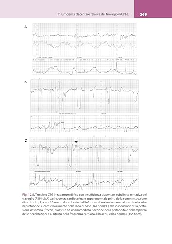 La Lettura Fisiopatologica Della Cardiotocografia Intrapartum - 3