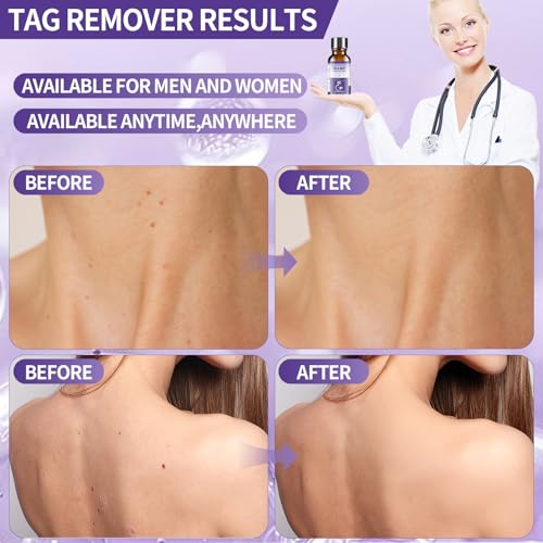 ANTIXYL 1Pcs Liquid Skin Tag Remover Kit, Wart Corn Remover, Fast-Acting Wart Remover Freeze Off,8% Salicylic Acid Wart Removal for PlantarWart, CommonWart, FlatWart, Callus (0.68 Fl Oz (Pack of 1 - Thumbnail 4