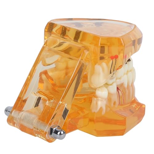 Natudeco Zahnmodell Dentalmodell Zahnkrankheits-Lehrmodell Dental Maxillary Overdenture Model Minderwertiges Präzisionsimplantat Demo with 4 Implantats for Zahnarztlaborklinik Zahnarztköpfe