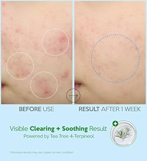 Troubless Hydro Soothing Moisture Cream - Deep Hydration & Skin Barrier Cream for Face w/ 10,000 ppm Panthenol & Tea Tree 4-Terpineol - Soothing & Non-Greasy Face Moisturizer (2.36 fl oz)