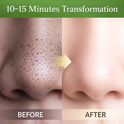 opasyo Blackhead Remover Strip, Charcoal Nose Pore Strips for Deep Cleansing, Pore Strips Blackhead Removal, Oil Control Nose Strips for Men & Women, All Skin Types (20Pcs)
