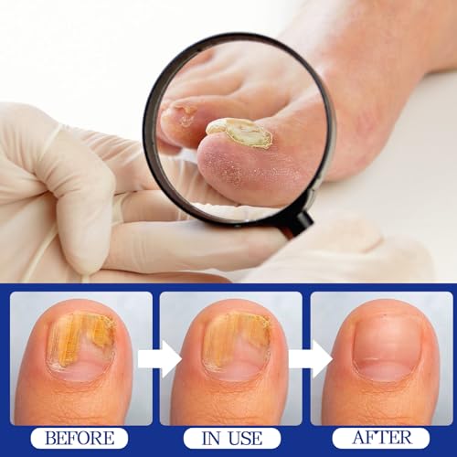 Apooliy 30ML Toenail Fungus Treatment Extra Strength - Image 4