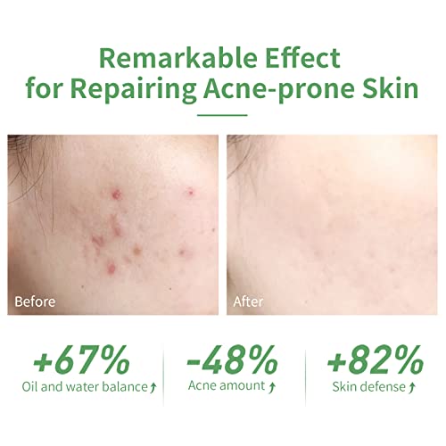 LANBENA Acne Treatment Face Serum, 10% Salicylic Acid, Pimples Remover & Dead Skin Peels, Relieve Redness Rosacea Blemish, Centella Asiatica Soothing Calming, Acne Prone Sensitive Facial Skin Care, 30ml