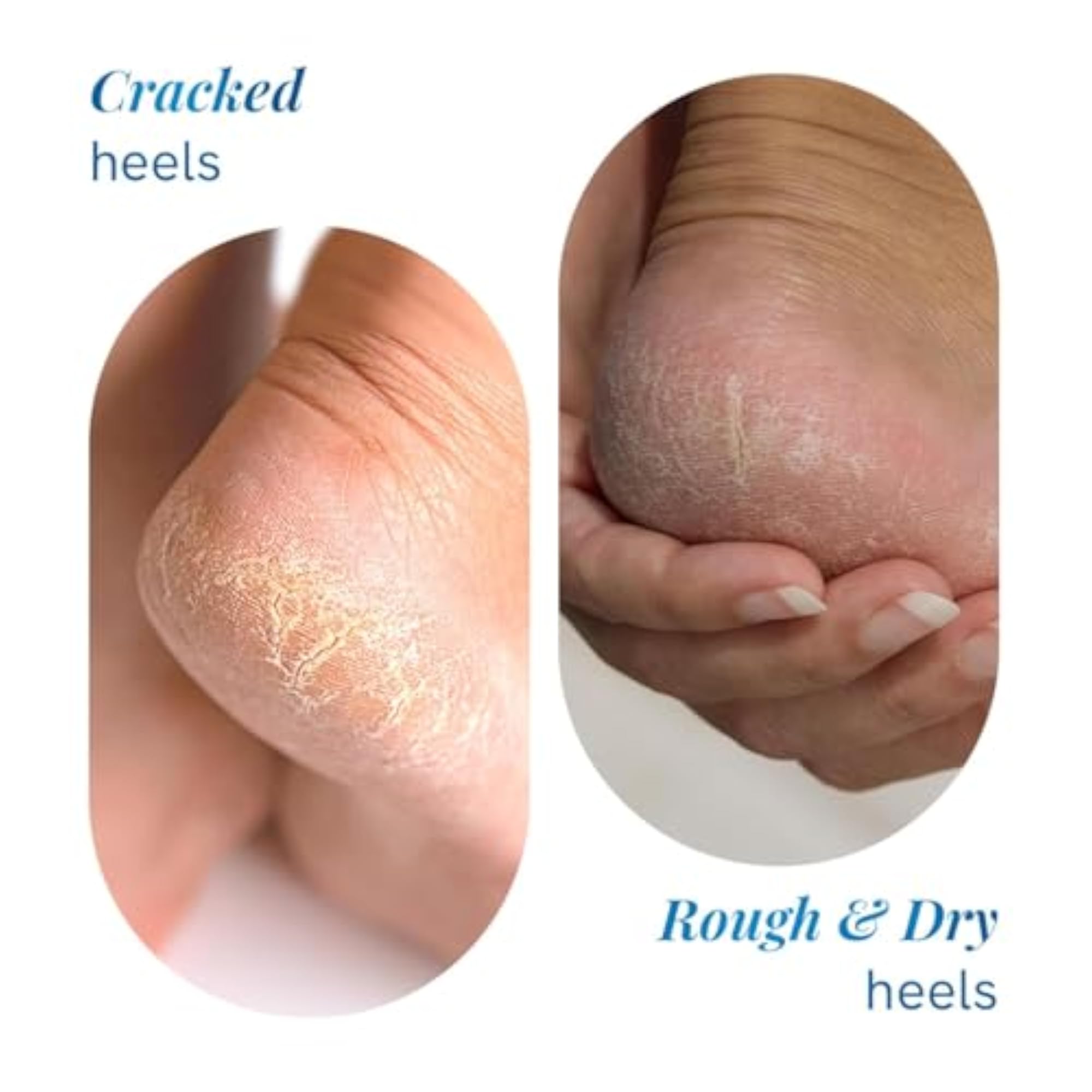 20% Urea Foot Cream Roll On, Dry & Cracked Heel Repair