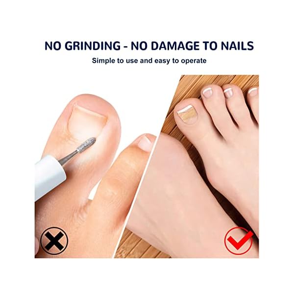 Ingrown Toenail Corrector Treatment Stickers, Glue-free Painless Ingrown Toenail Corrector Strips, Pedicure Toenail Corrector Patch, Professional Toenail Treatment Tool for Foot Care (150pcs) - Image 6