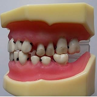 Dental Periodontal Disease Model, Periodontal pathological Model (L4 Periodontal Disease Model)
