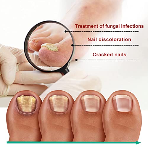 3Pcs Kerassentials For Toenail Treatment, Toenail Treatment Extra Strength For Repairing Damaged And Discolored Nails #TOP7