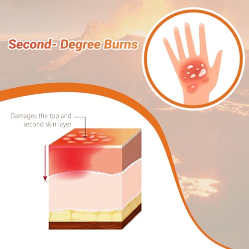 Image of Burn Wound Packing Trainer, Burn Moulage, Adhesive Skin Burn Wound Trainer for Wound Care Training, Second Degree Burn Wound Training Model