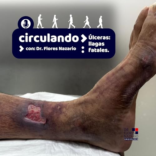 Úlceras: llagas fatales.