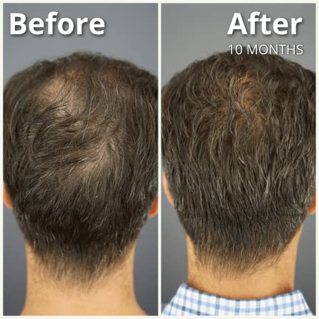 Miniatura 5 de Dr.UGro Gashee Suplemento para el crecimiento del cabello para hombres y mujeres vitaminas para el cabello más grueso y fuerte. Promueve el