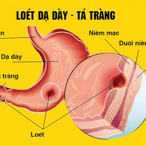 V&igrave; sao bệnh dạ d&agrave;y thường b&ugrave;ng ph&aacute;t v&agrave;o m&ugrave;a lạnh?