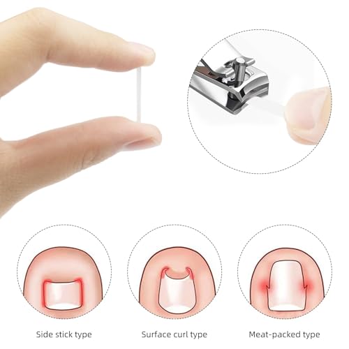 Kit de ferramentas de unhas encravadas com lixa de unha encravada e levantadores com 30 tiras de unh
