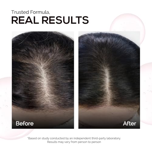 Image of KORE Anti Hair Fall Multi-Peptide Shampoo | Clinically Crafted for Up to 95% Hair Fall Reduction | Powered with KORE Dense Technology | Copper Peptide, Leucine & Tyrosine | Repairs Dry & Damaged Hair | 200 ml