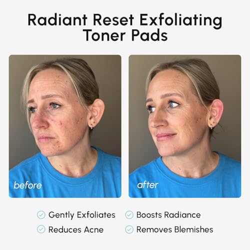 Image of MAREE Glycolic Acid Pads - Toner Pads for Face Cleansing - Exfoliating Pad with Tea Tree Oil, Salicylic Acid & Vitamins E, B3, B5 - Acne Clearing, Skin Pore Resurfacing & Radiance Device - 80 Count