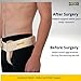URIEL Hernia Belts for Men I Fits Left Side I Inguinal Hernia Belt for Men I Hernia Support I Pre & Post Surgery Hernia Truss I Adjustable Waist Strap with Compression Pad I Cream, XL Size