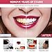 Professional Teeth Whitening Kit with 5 Teeth Whitening Gel, LED Accelerator Light & Rechargeable Design - Enamel Safe Gel, Custom Trays, Fast Results for Sensitive Teeth - Whitening Gel Kit​​