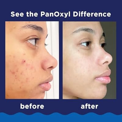 PanOxyl 10% Acne Foaming Wash 5.5 Ounce (Value Pack of 2)