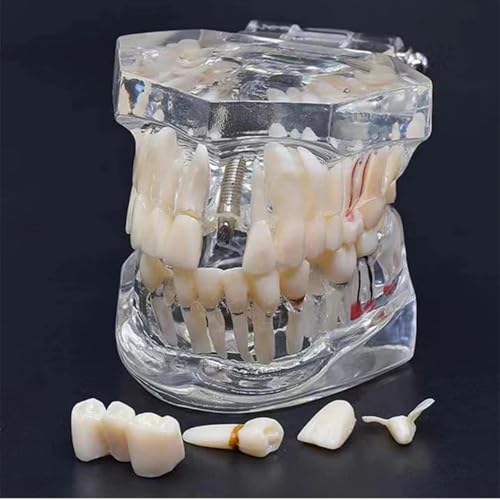 Natudeco Zahnmodell Dentalmodell Zahnkrankheits-Lehrmodell transparent, Demonstrationszahnmodell Zähneputzen, Zahnseide orales pathologisches Modell für den Schulunterricht, Forschung