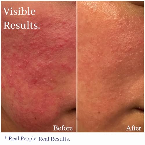 Hey Honey Skincare Relax - Rosacea Relief Cream for Sensitive Skin | Calming Face Moisturizer for Facial Redness & Irritation | Dermatologist Tested, Oil-Free with Honey & Propolis | 2.2 Oz - Image 3