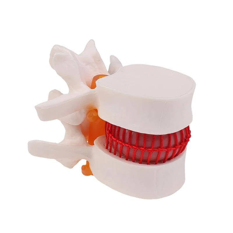 Image of Human Anatomical Lumbar Disc Herniation Model,1.5 Times Life Size Portable Lumbar Vertebrae Model ，Anatomy Medicine Teaching Tool for Medical Learning and Scientific Presentations