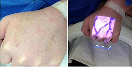 Infrared Vein Finder Viewer - Handheld Vein Locator, Vein Illumination Detector, Vein Light Projection Visualization for Nurses, Works with All Skin Types (Portable)