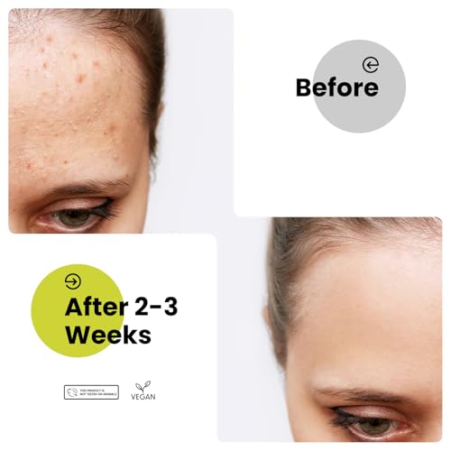 Amifiy Microcrystal Dark Spot Patches, Korean Skincare Post-Blemish Redness Cover on Body & Face, Acne Pimple Spot Remover with Vitamin C, Kojic Acid & Tranexamic Acid, 9 Count