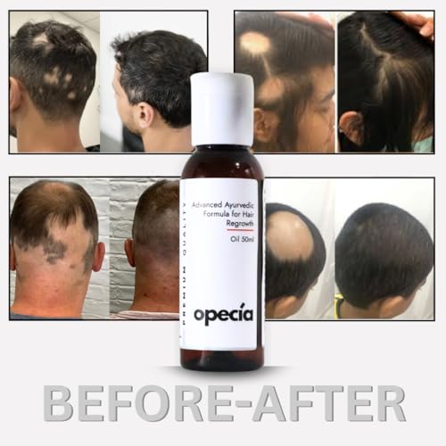 Image of Alopecia Hair Patch Regrowth Oil (50ml) Alopecia Areata Treatment Oil | 100% Pure Extract with No Side Effects