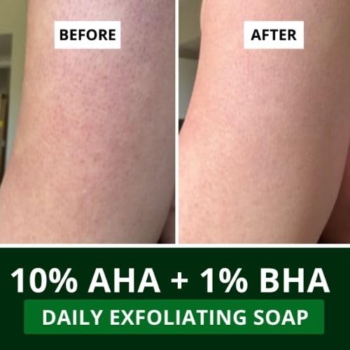 Image of BAKE 10% AHA + 1% BHA Scrub Treatment Soap with Lactic Acid, Glycolic Acid, 1% Salicylic Acid | For Clogged Pores, Exfoliation, Strawberry Skin & Bright Underarms | Soap for Women & Men | 100g x 3 (Pack of 3)