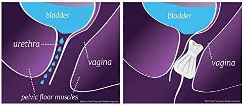 Poise Impressa Incontinence Bladder Supports, Size 2, 10 Count
