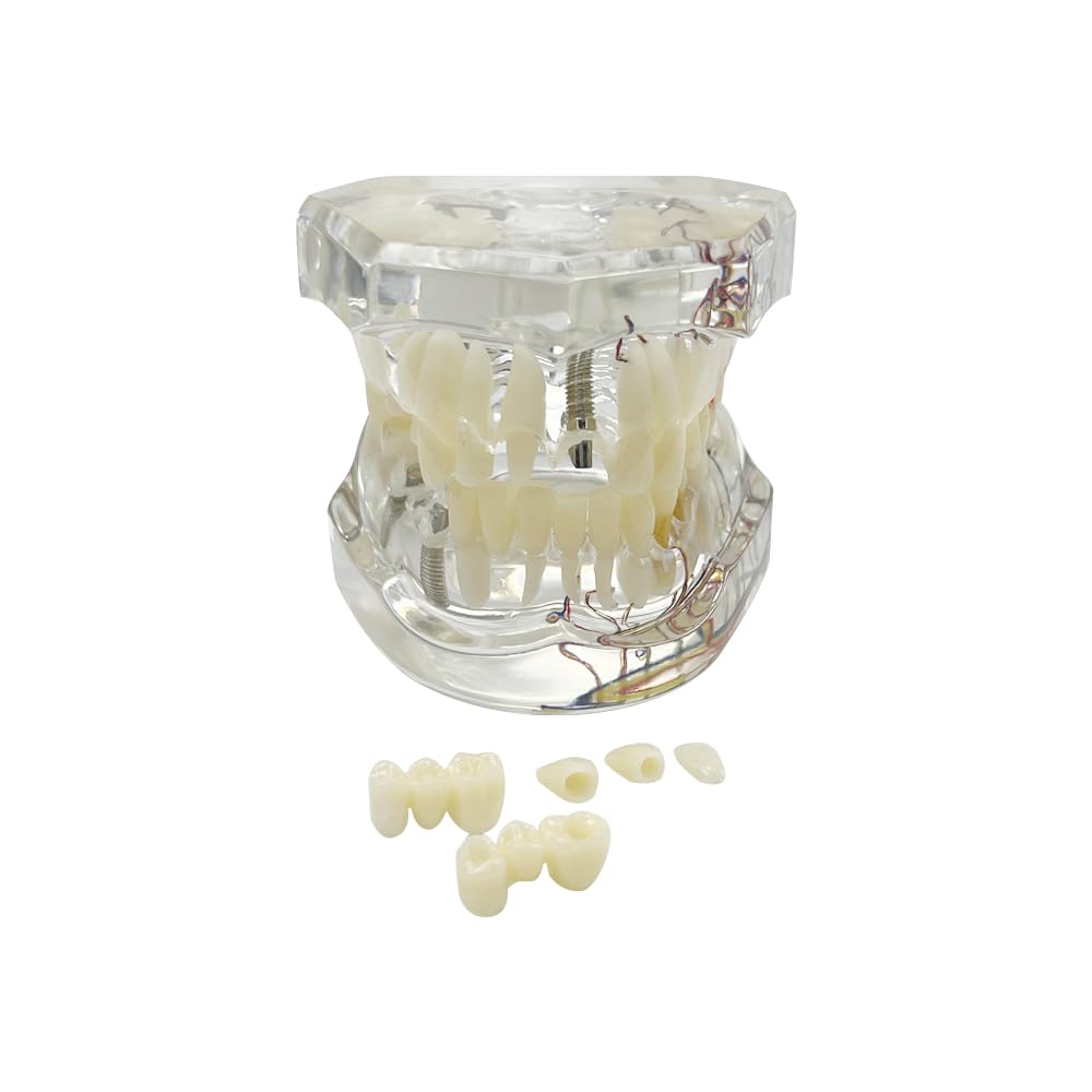 Modello dentale di riparazione neurale Modello dentale Malattia dell'impianto Modello dei denti Dentista Modello di insegnamento patologico standard dei denti rimovibili