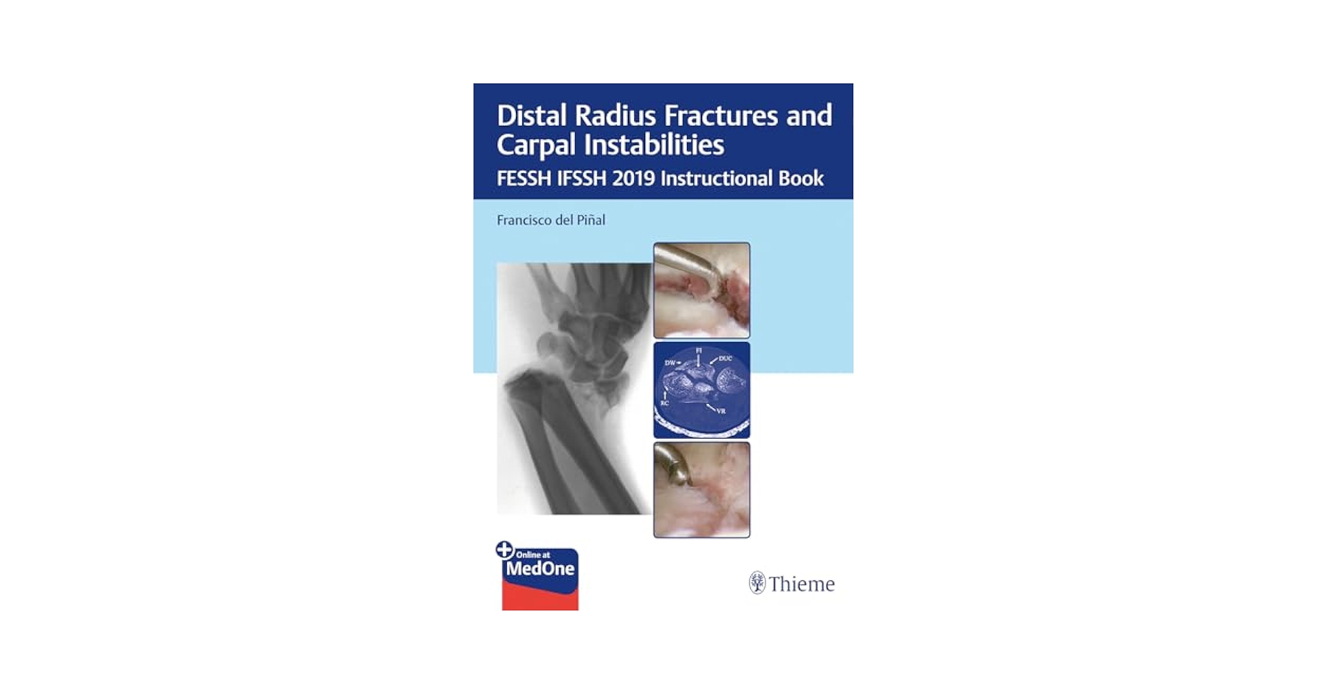Distal Radius Fractures and Carpal Instabilities: FESSH