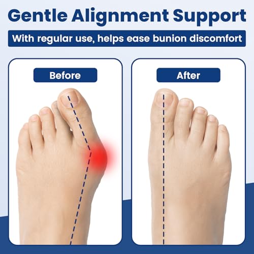 AnjoCare Hallux Valgus Trainingsbänder(3er Pack), Zehenspreizer zur Ballenzehen-Korrektur & Schmerzlinderung, Ballenkorrektur für Zehenausrichtung & Beweglichkeitstraining