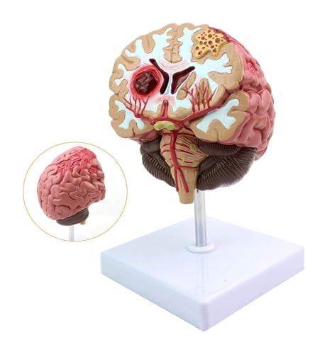 Modelo anatómico de hemorragia cerebral del tronco encefálico y patologías formativas 3