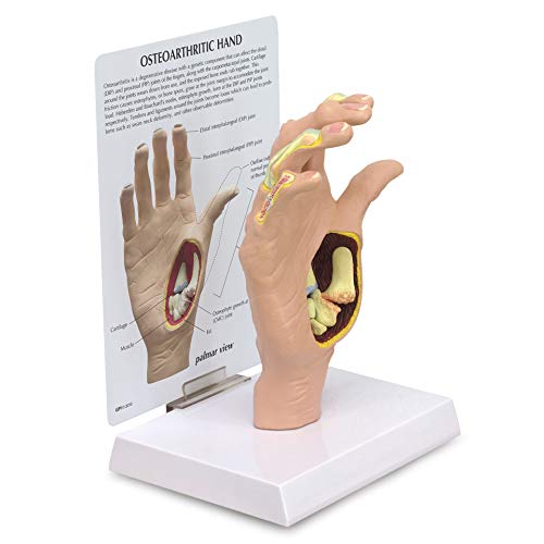 Hand Model | Human Body Anatomy Replica of Hand w/Osteoarthritis for Doctors Office Educational Tool | GPI Anatomicals