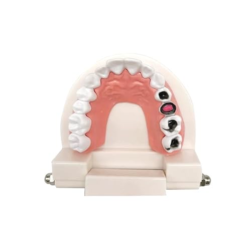 Miniatura 4 de Modelo de estudio de caries dentales, modelo de dientes de caries para enfermedad, modelo estándar de demostración de tipodonto, para niños,