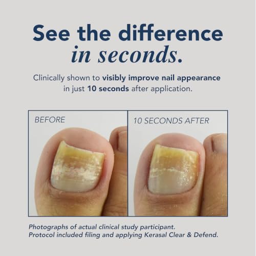 Image of Kerasal Clear & Defend Nail Renewal, Better Looking Nails,0.33 oz + 5 Files