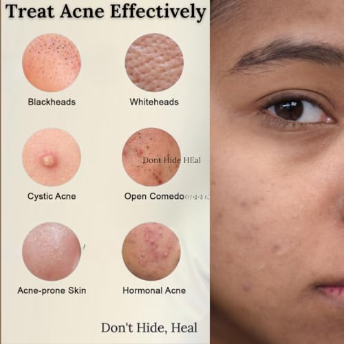 Image of Teen Anti-Acne Cream | Ideal for Ages 13 to 19 (Teen) | Natural Lightweight Moisturizer with Tea Tree Oil Neem Niacinamide & Himalayan Seabuckthorn | BHA-Based Acne Treatment | Soothes Hydrates & Clears Breakouts | Paraben-Free Sulfate-Free Vegan | 50 g