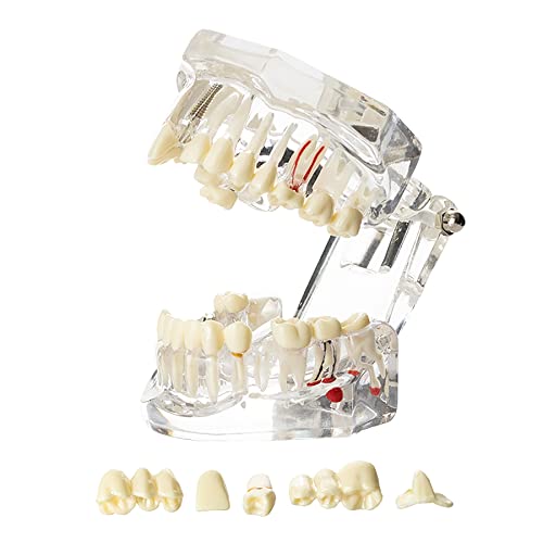 Dentalmall Implant Pathological Model