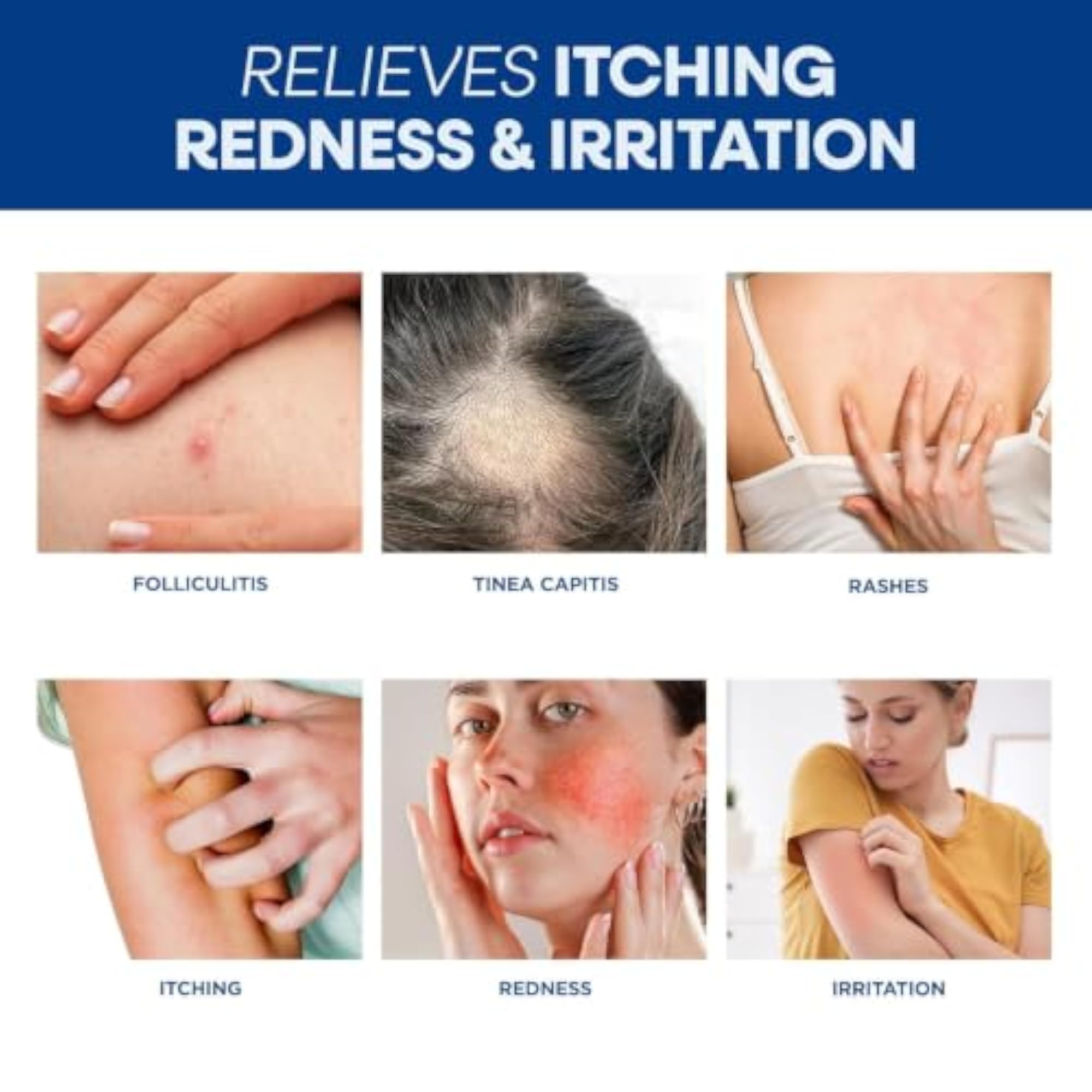 Advanced Folliculitis Cream for Skin Irritation