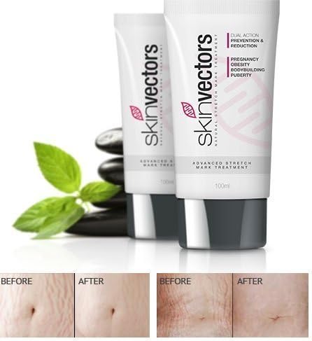 SkinVectors Stretch Mark Removal Cream Clinical Strength (100ml) by SkinVectors