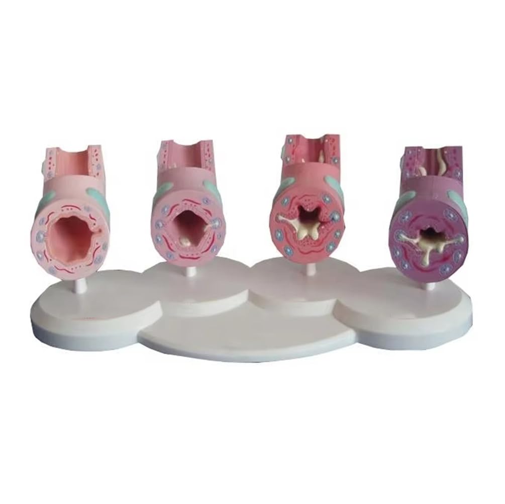 YRQMGSF Human Large Intestine Anatomy Model -Intestinal Pathology Model - for Education Demonstration
