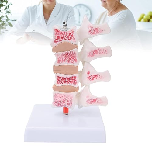 Modèle de spine pathologique lombaire AMITD en taille réelle avec base - 2