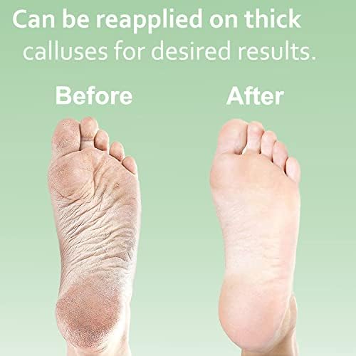 Dr. Entre's Callus Remover for Feet: 8oz Callus Remover Gel, Foot File, Pumice Stone, 5 Glove Pairs, Corn Remover for Feet, Spa Kit, Foot Callus Remover, Corn Removal Treatment