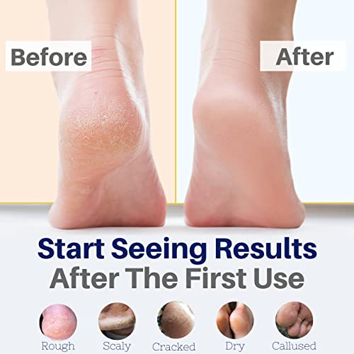 Yellow Bird Foot Cream – Hydrating Tea Tree Oil Foot Balm With Essential Oils. Natural Athletes Foot Treatment. Moisturizing Cracked Feet Repair & Callus Remover. Made In Usa - 2 Oz #TOP1