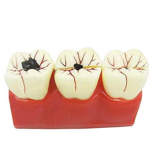 Modèle d'évolution des caries dentaires pour formation et démonstration clinique