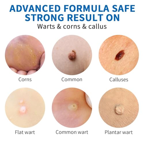 Hengulus Wart Removal Cream,Salicylic Wart Remover for Men Women,Fast-Acting Plantar Wart Remover for Feet,Corn Removers for Toes-NDC Codo(s):84010-036-01 - Thumbnail 3