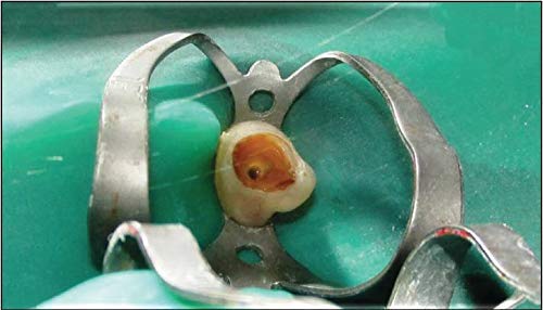 SURGICAL ONLINE (Lot of 3) Endodontic Rubber Dam Clamps # 206