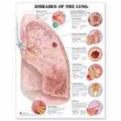 Preisvergleich Produktbild Anatomical Chart Company: Diseases of the Lung Anatomical Ch