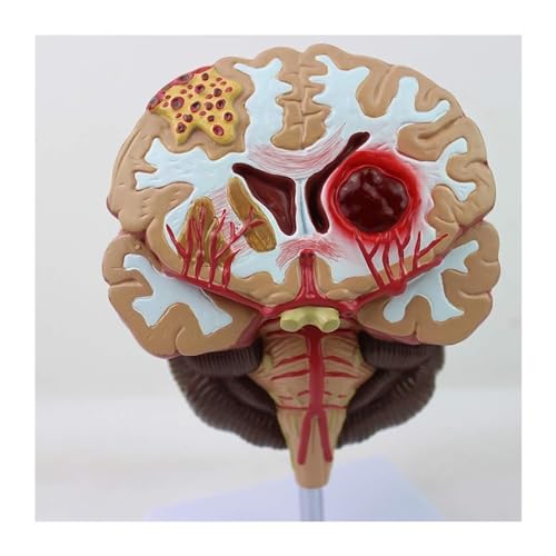 Modelo anatómico de hemorragia cerebral del tronco encefálico y patologías formativas 2