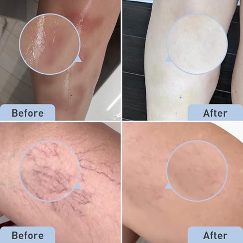 image for PROcure Bruise Remedy Gel – Arnica Montana & MSM for Reducing Appear